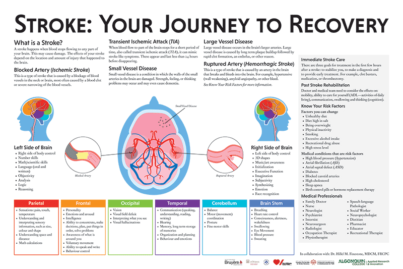 A stroke poster highlighting what a stroke is, where a stroke can happen, and signs of a stroke